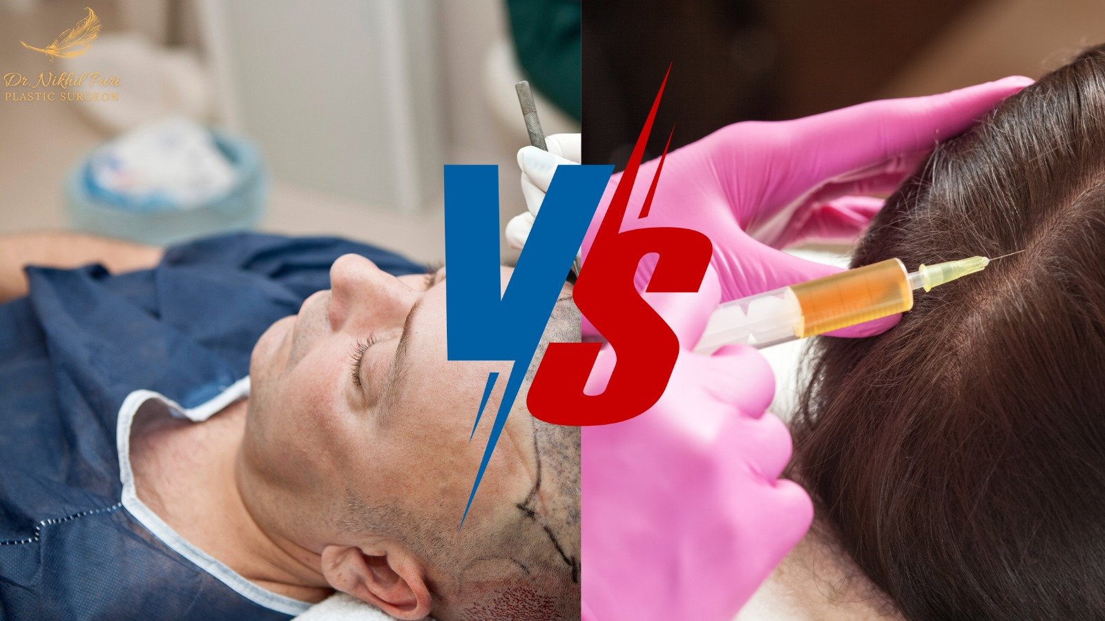 PRP vs. Hair Transplant