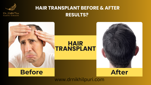 Hair Transplant