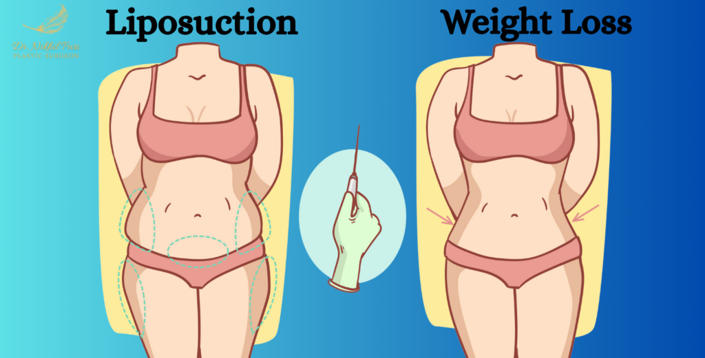 Liposuction vs Weight Loss