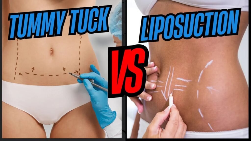 Comparison of tummy tuck vs liposuction results by Dr. Nikhil Puri – liposuction in Lucknow